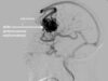 Brain-angiogram-showing-brain-arteriovenous-malformation 1200