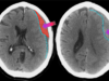 hematoma subdural