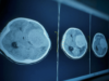 tomografia-cerebral (1)