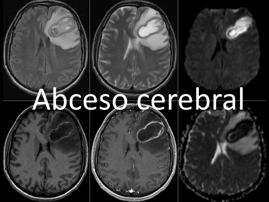 Abceso cerebral (1)