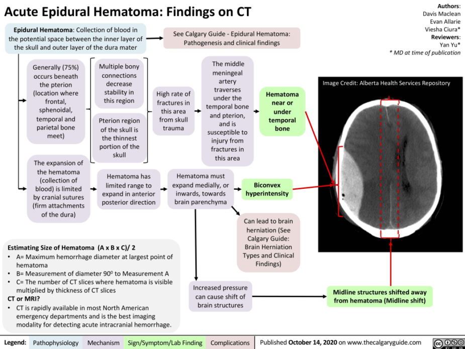 Epidural-Hematoma-Findings-on-CT (1)