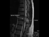 MRI-sagital-view-showing-medullary-compression-by-tumor (1)