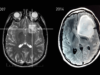 MRI_Slices_-_2007_and_2014_of_astrocytoma_patient_-_Steven_Keating (1)