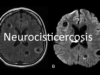 Neurocisticercosis (1)
