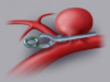 cerebral-aneurysm-clip (1)