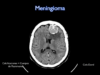 meningioma1-l (1)