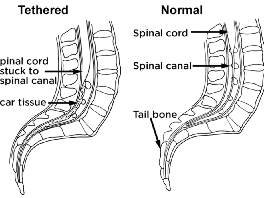tethered-spinal-cord-1 (1)