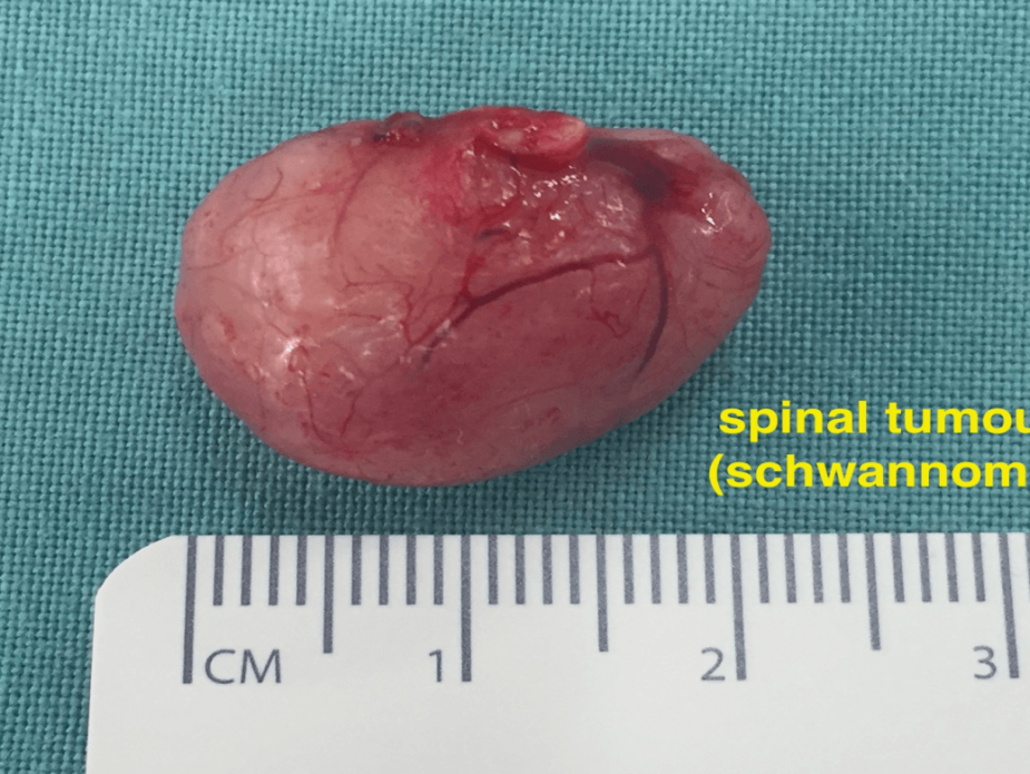 tumor medula espinal 3 (1)
