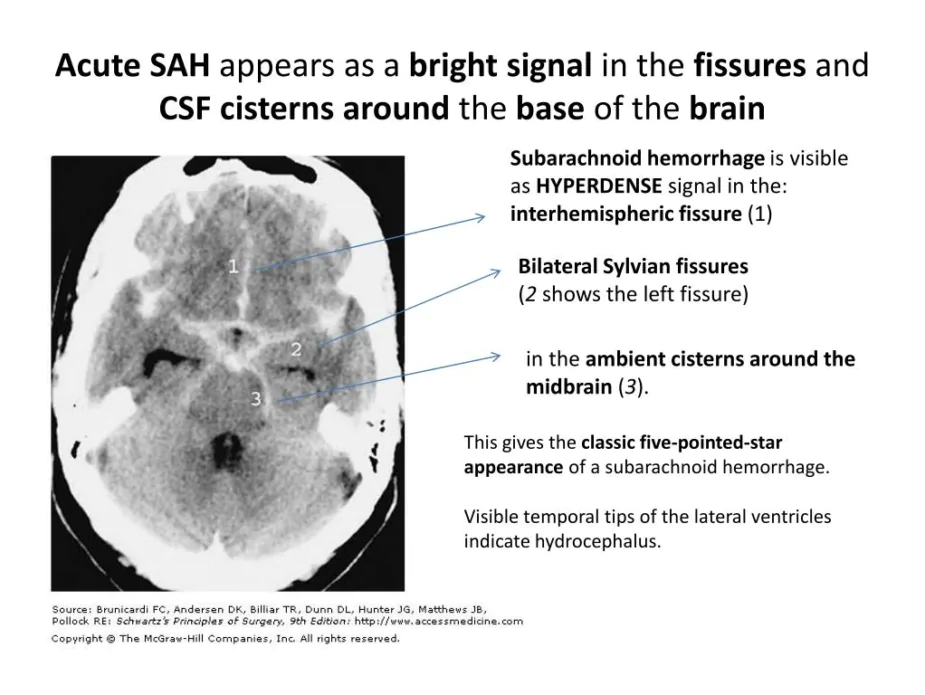 acute-sah-appears-as-a-bright-signal-in-the-fissures-and-csf-cisterns-around-the-base-of-the-brain-l (1)