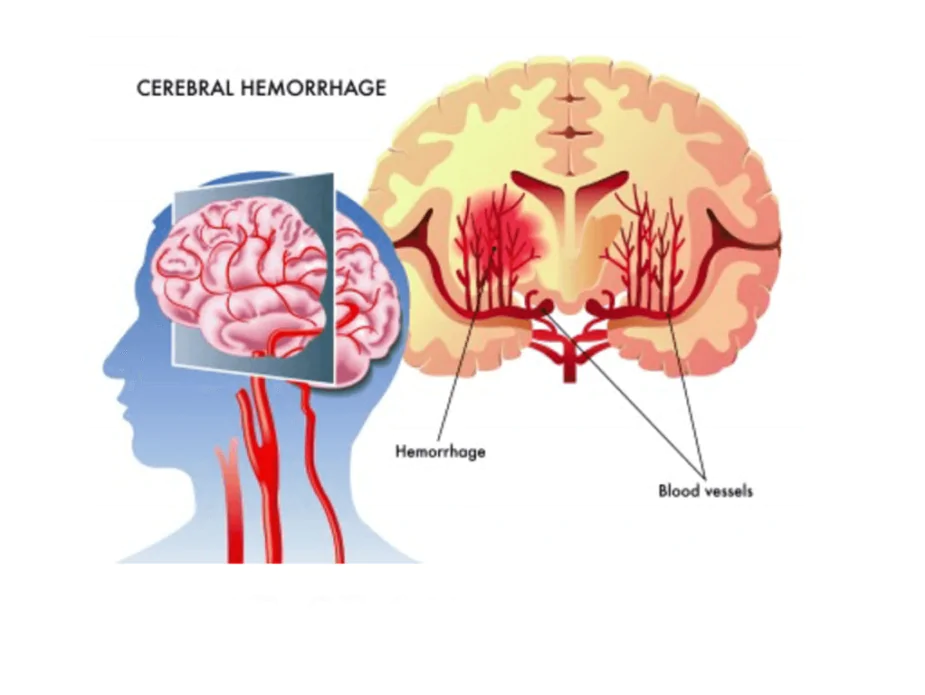 hemorragie-cerebrale-schema T