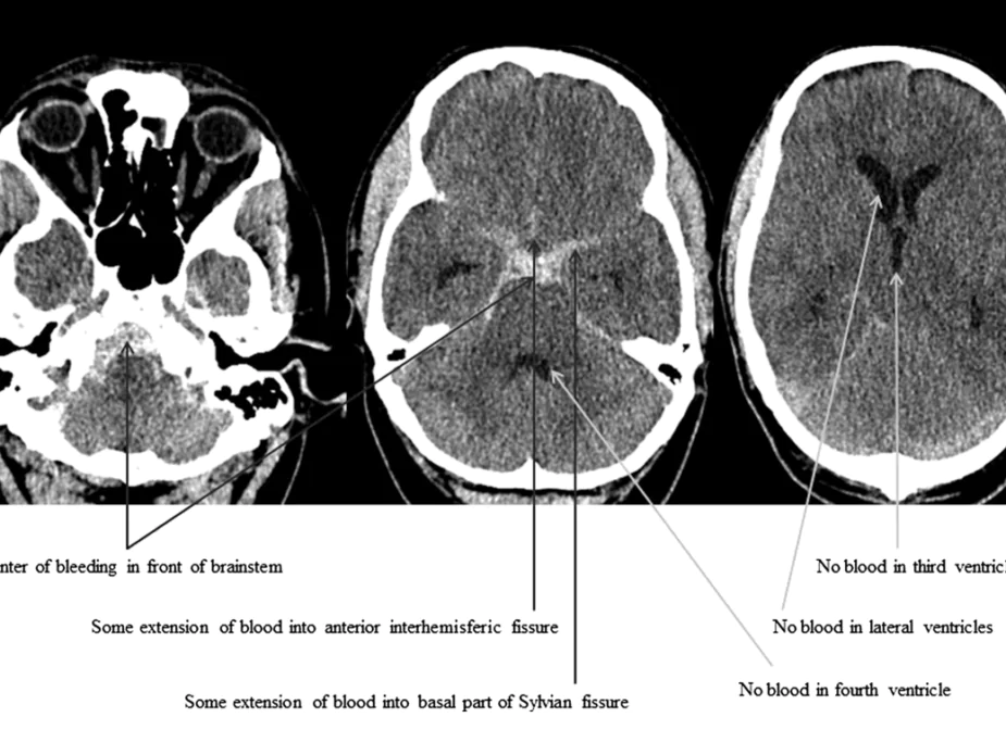neurology-hemorrhage-diagnosis-clinical-em-original (1)